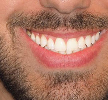 Resultado Después 2